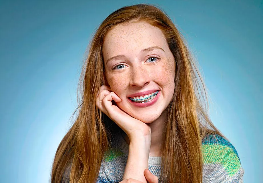 Traditional dental braces in Marysville