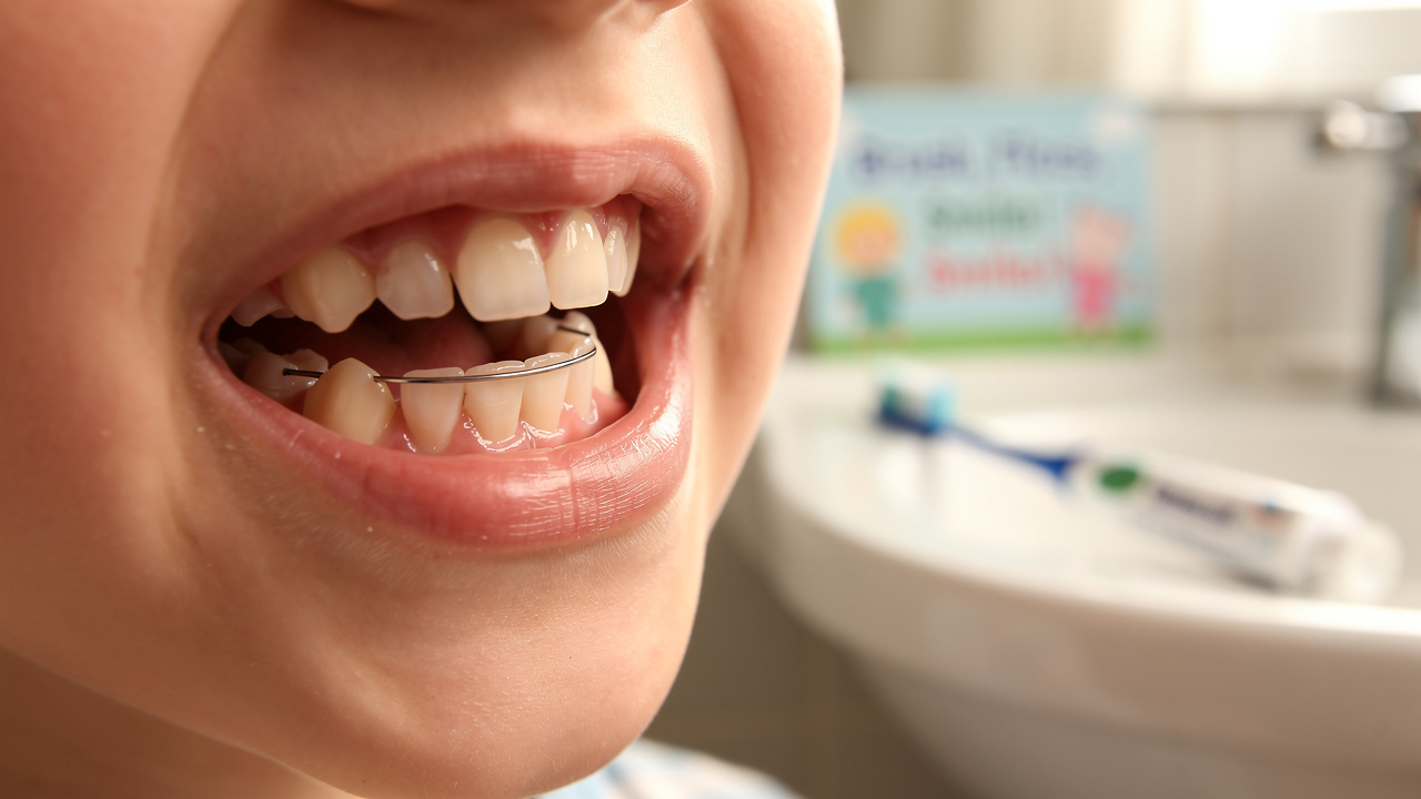 essential-tips-for-caring-for-permanent-retainers-in-kids