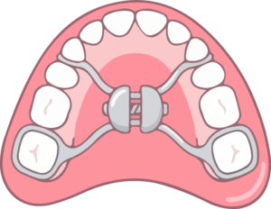 Palatal Expander for children, pediatric orthodontics, Smokey Point Orthodontics